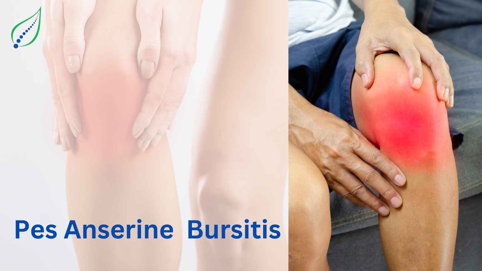 Pes Anserine Bursitis